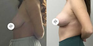This is one of our beautiful breast reduction patient 76