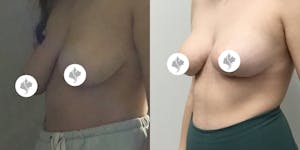 This is one of our beautiful breast reduction patient 76
