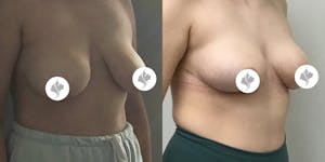 This is one of our beautiful breast asymmetry correction patient 15