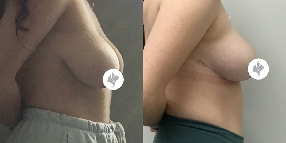 This is one of our beautiful breast asymmetry correction patient #15