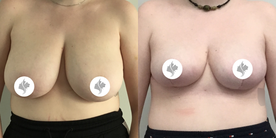 This is one of our beautiful breast reduction patient 13
