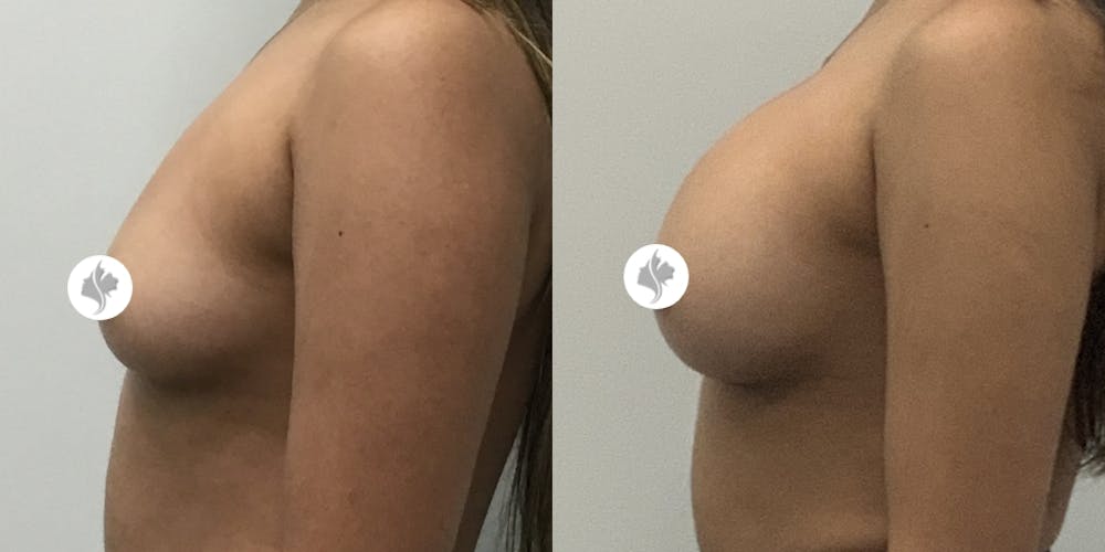 This is one of our beautiful breast augmentation patient #22