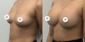 This is one of our beautiful breast augmentation patient 22