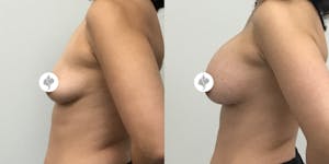 This is one of our beautiful breast augmentation patient 23