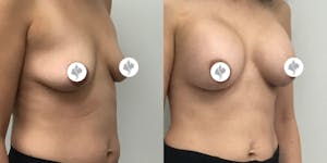 This is one of our beautiful breast augmentation patient 23