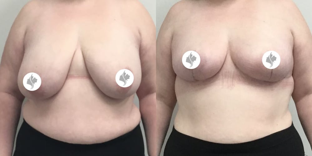 This is one of our beautiful breast reduction patient #77