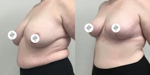 This is one of our beautiful breast reduction patient 77