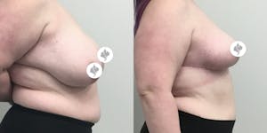 This is one of our beautiful breast reduction patient 77
