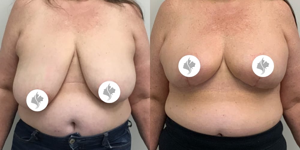 This is one of our beautiful breast reduction patient #78