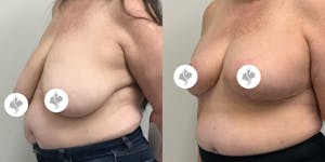 This is one of our beautiful breast reduction patient 78