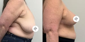 This is one of our beautiful breast reduction patient 78