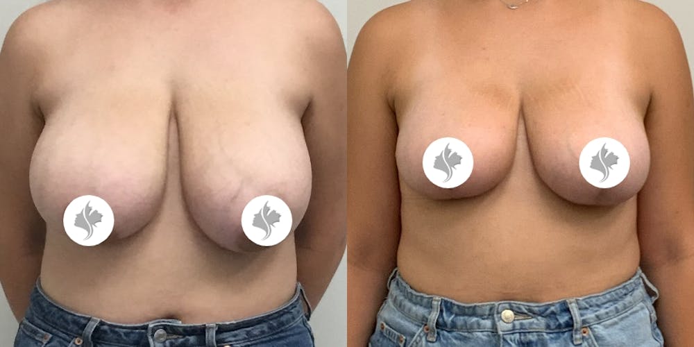 This is one of our beautiful breast reduction patient #15