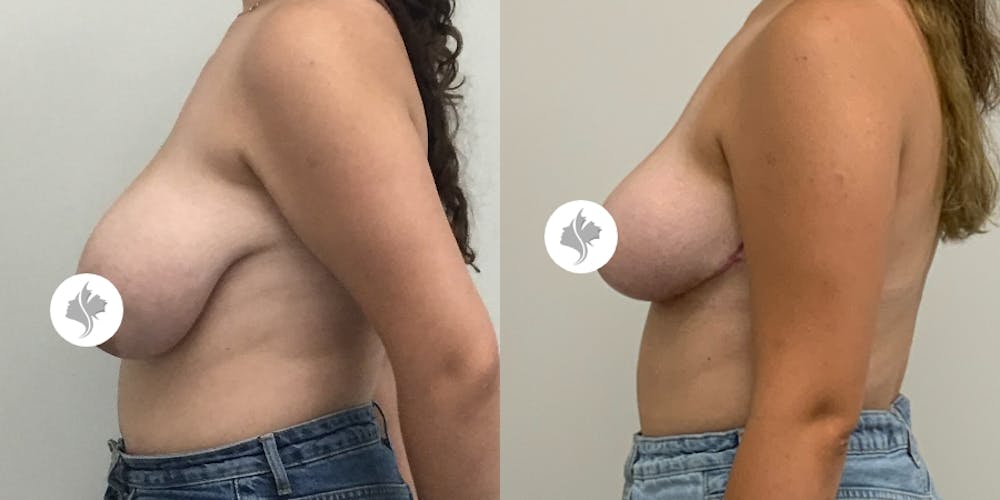 This is one of our beautiful breast asymmetry correction patient #8