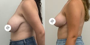 This is one of our beautiful breast asymmetry correction patient 8