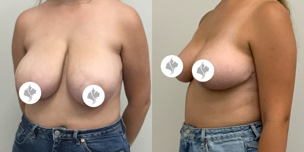 This is one of our beautiful breast asymmetry correction patient #8