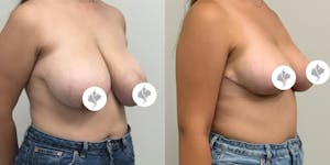 This is one of our beautiful breast asymmetry correction patient 8