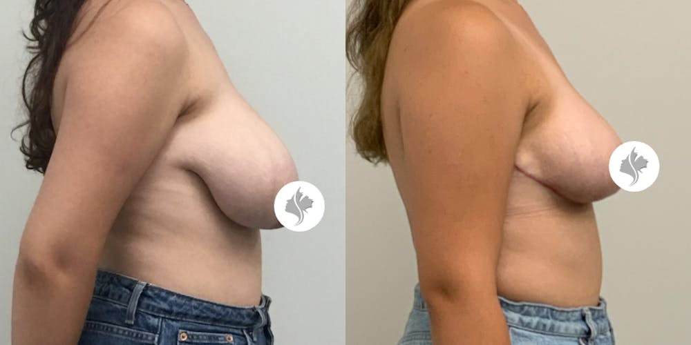 This is one of our beautiful breast asymmetry correction patient #8