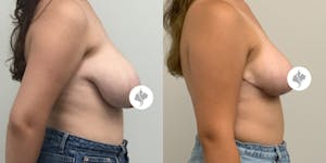 This is one of our beautiful breast asymmetry correction patient 8