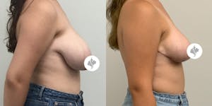 This is one of our beautiful breast reduction patient 15
