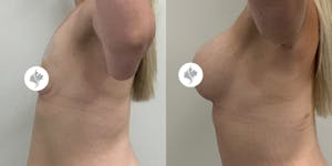 This is one of our beautiful breast augmentation patient 24