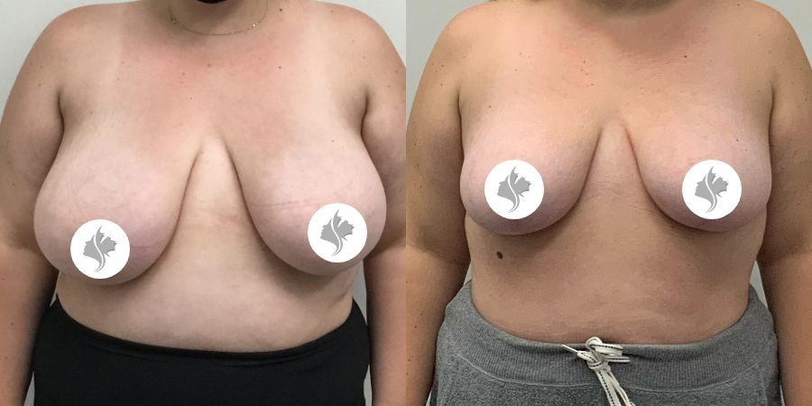 This is one of our beautiful breast reduction patient 79
