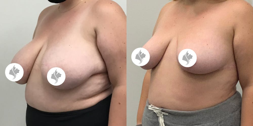 This is one of our beautiful breast reduction patient #79