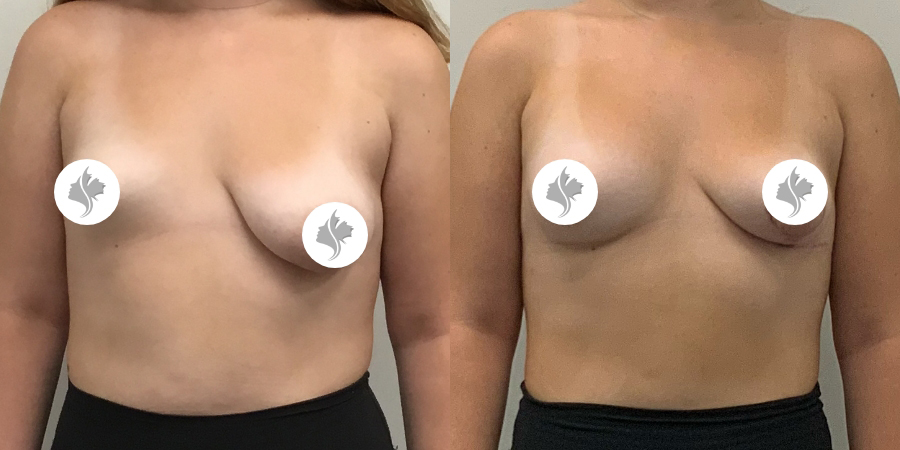 This is one of our beautiful breast asymmetry correction patient 17