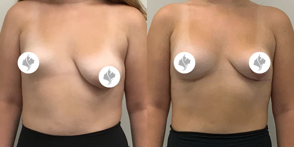 This is one of our beautiful breast asymmetry correction patient #17