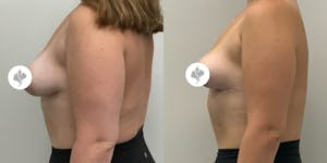 This is one of our beautiful breast asymmetry correction patient 17