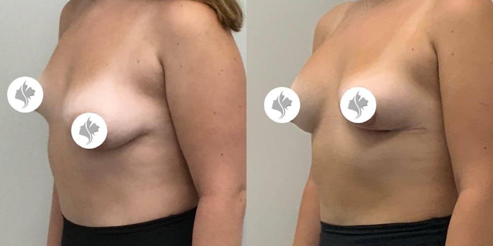 This is one of our beautiful breast asymmetry correction patient #17