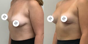 This is one of our beautiful breast asymmetry correction patient 17