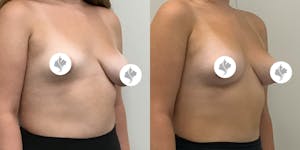 This is one of our beautiful breast asymmetry correction patient 17