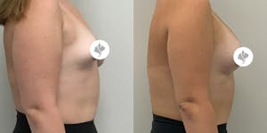 This is one of our beautiful breast asymmetry correction patient 17