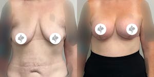 This is one of our beautiful breast augmentation with lift patient 1