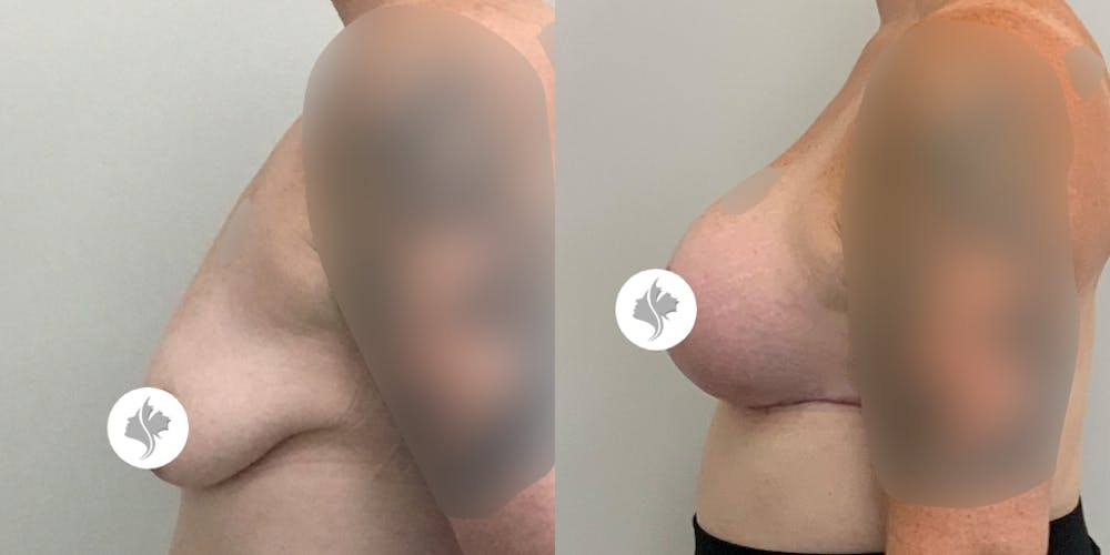 This is one of our beautiful breast augmentation with lift patient #1