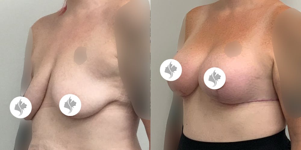This is one of our beautiful breast augmentation with lift patient #1