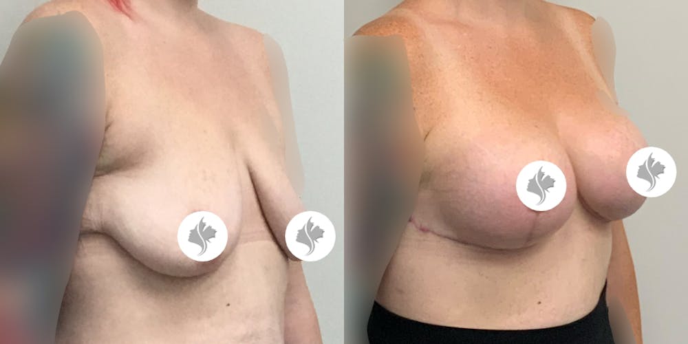 This is one of our beautiful breast augmentation with lift patient #1