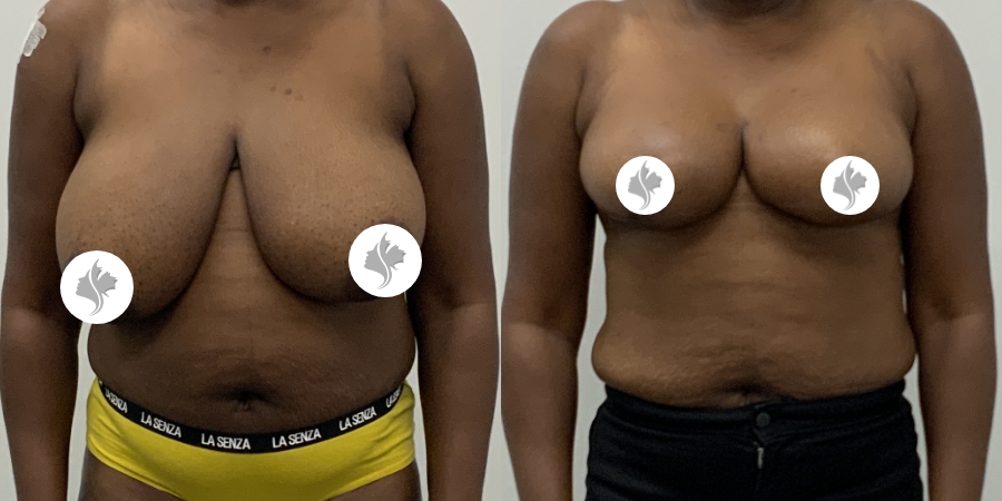 This is one of our beautiful breast asymmetry correction patient 18