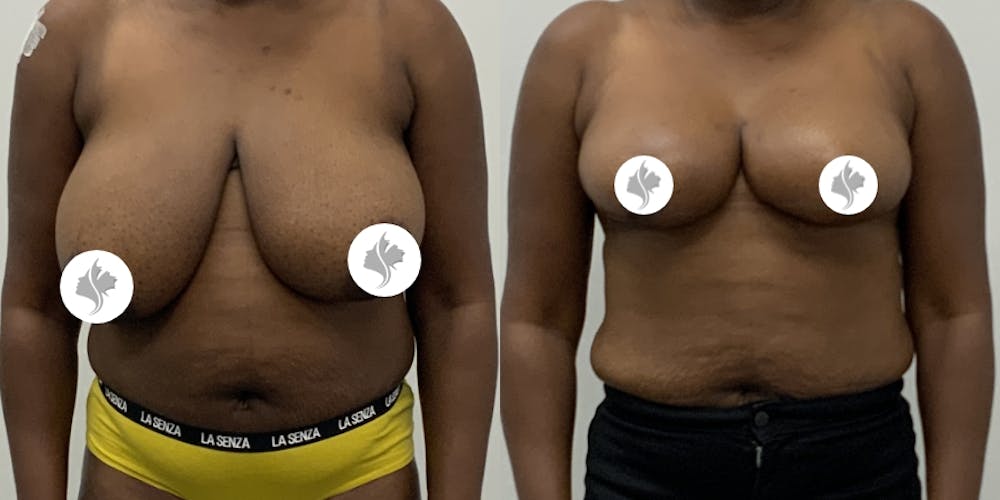 This is one of our beautiful breast reduction patient #81