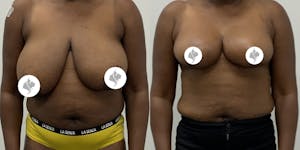 This is one of our beautiful breast asymmetry correction patient 18