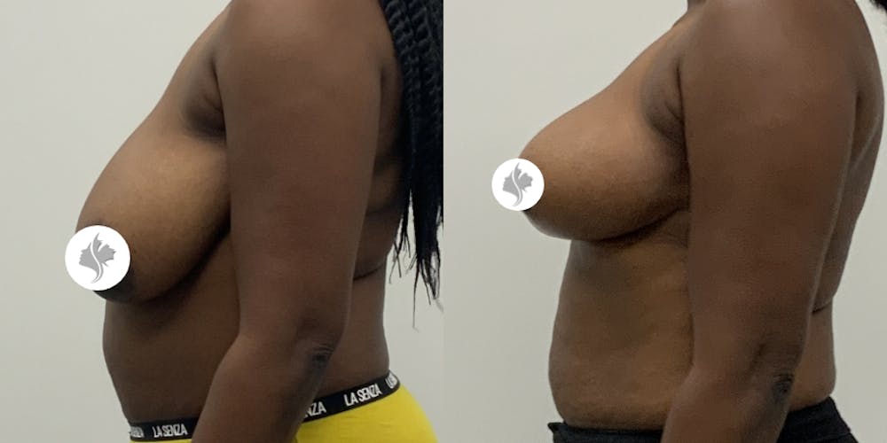 This is one of our beautiful breast asymmetry correction patient #18