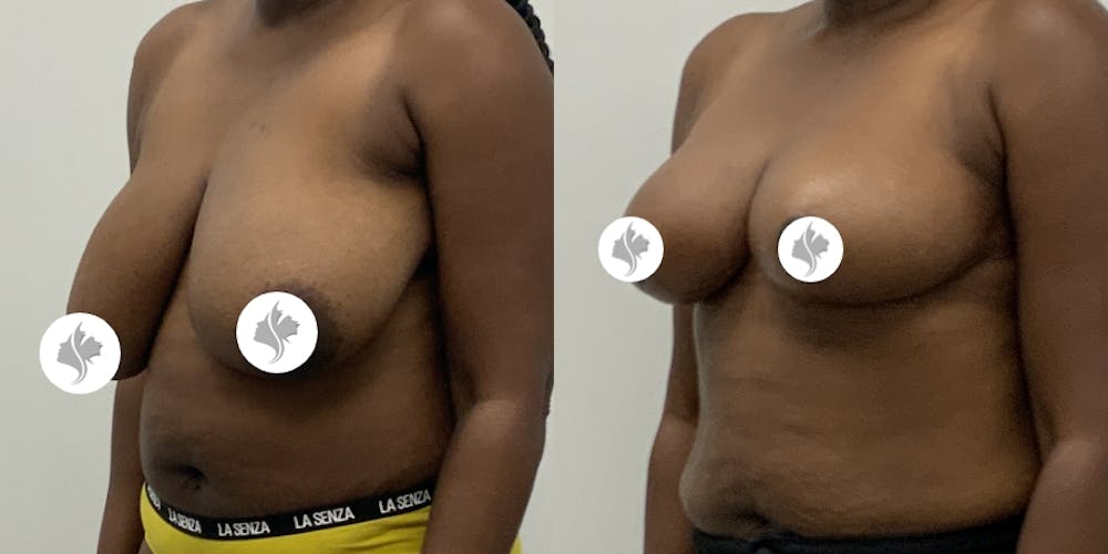 This is one of our beautiful breast asymmetry correction patient #18