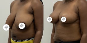 This is one of our beautiful breast asymmetry correction patient 18