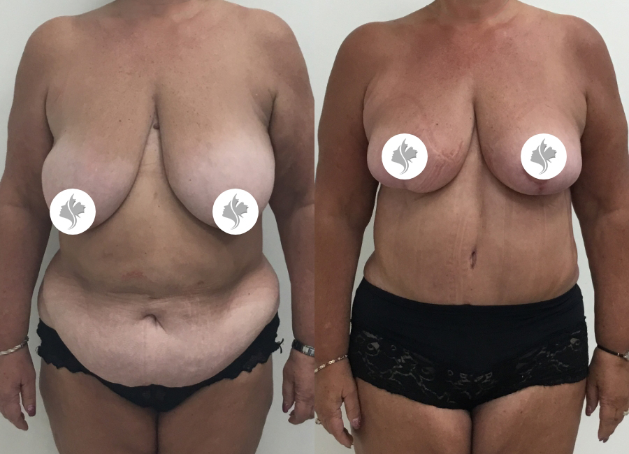 This is one of our beautiful post-bariatric body contouring patient 57