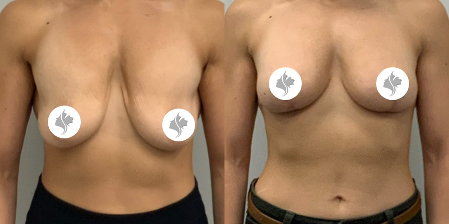 This is one of our beautiful breast asymmetry correction patient 19