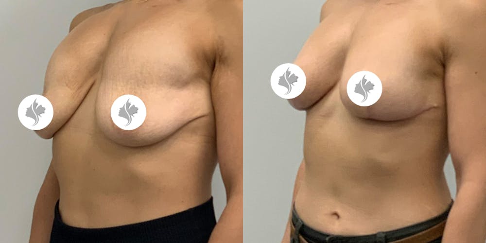 This is one of our beautiful breast asymmetry correction patient #19