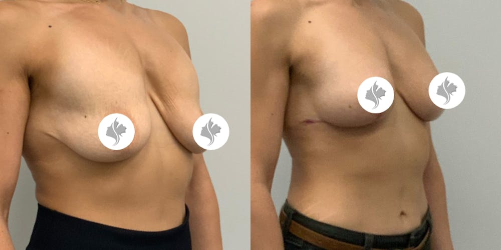 This is one of our beautiful breast asymmetry correction patient #19