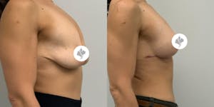 This is one of our beautiful breast asymmetry correction patient 19
