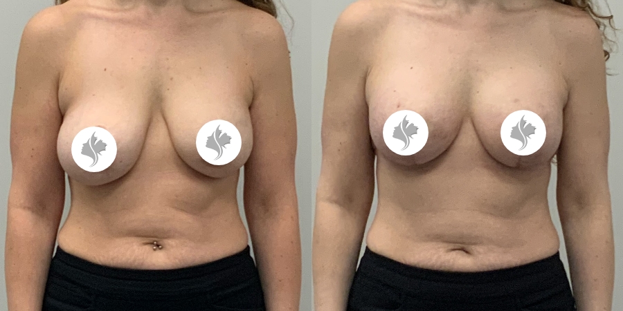 This is one of our beautiful breast asymmetry correction patient 20