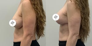 This is one of our beautiful breast reduction patient 85